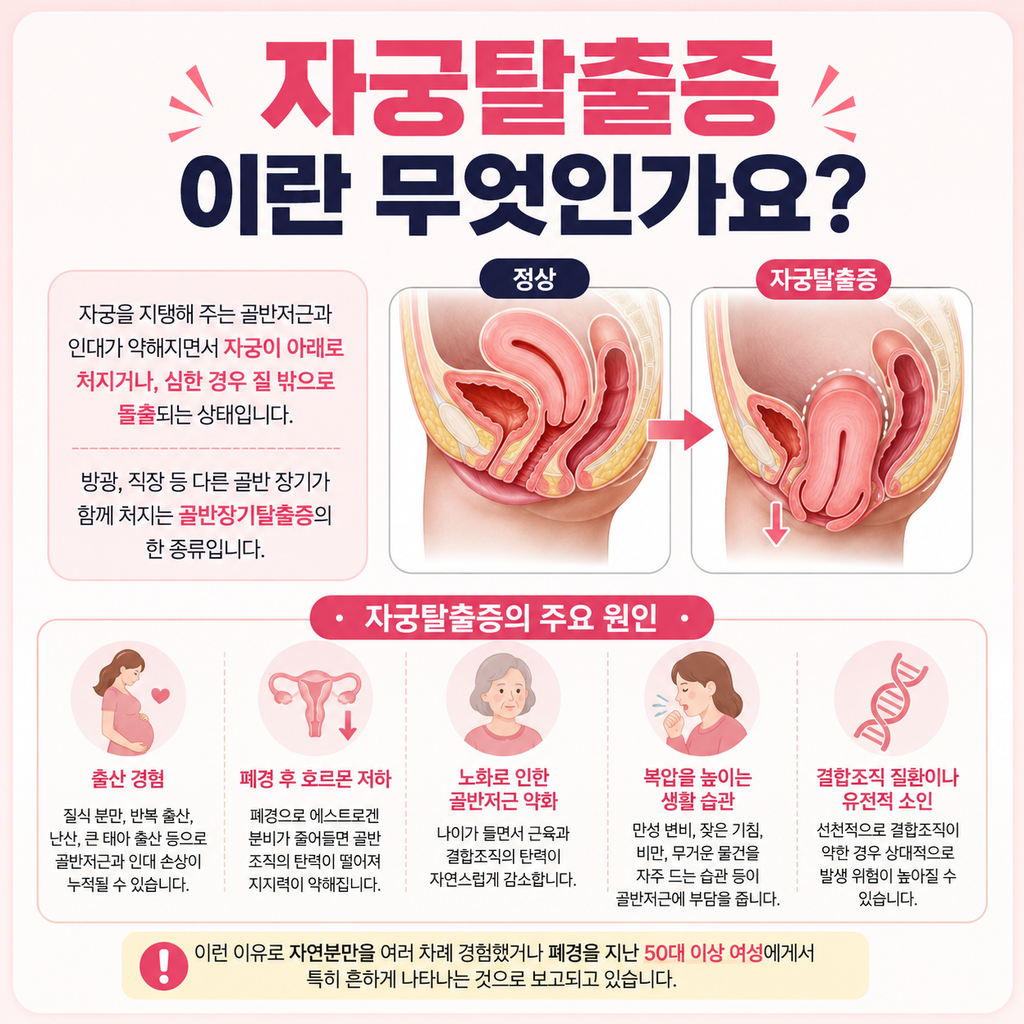 자궁탈출증, 50대 이후 여성이라면 꼭 알아야 할 증상과 치료법