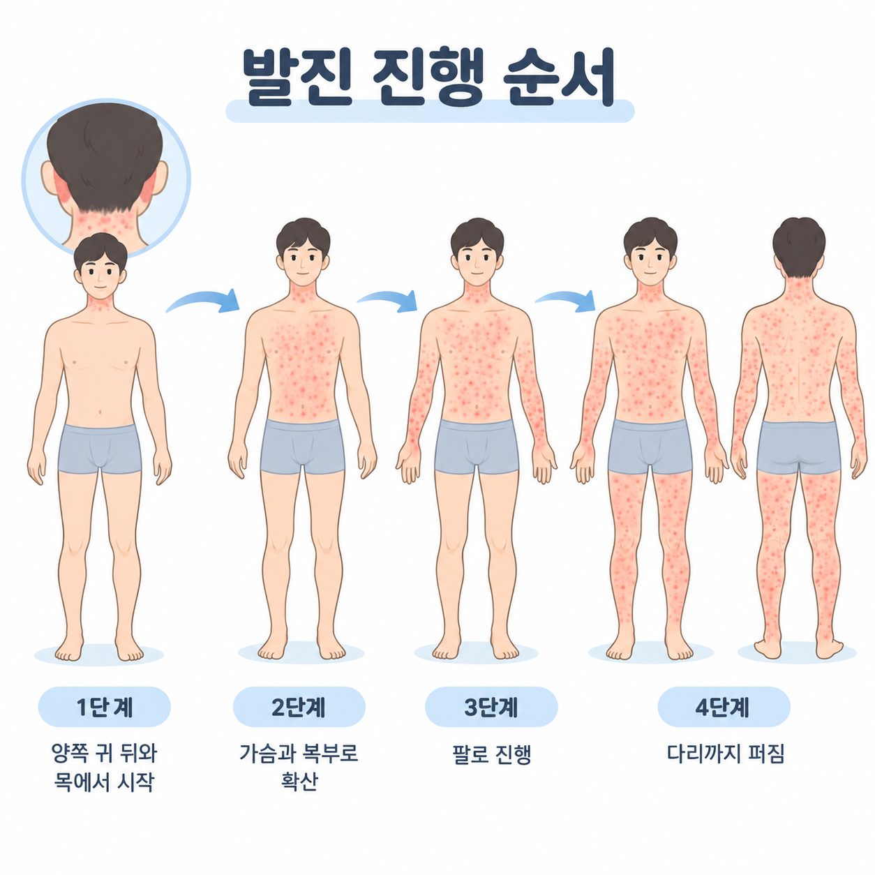 홍역 증상 순서와 발진 특징, MMR 예방접종 안내 3 홍역 발진 진행 순서